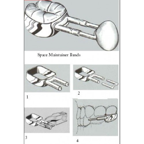 Band Space Maintainer Kit